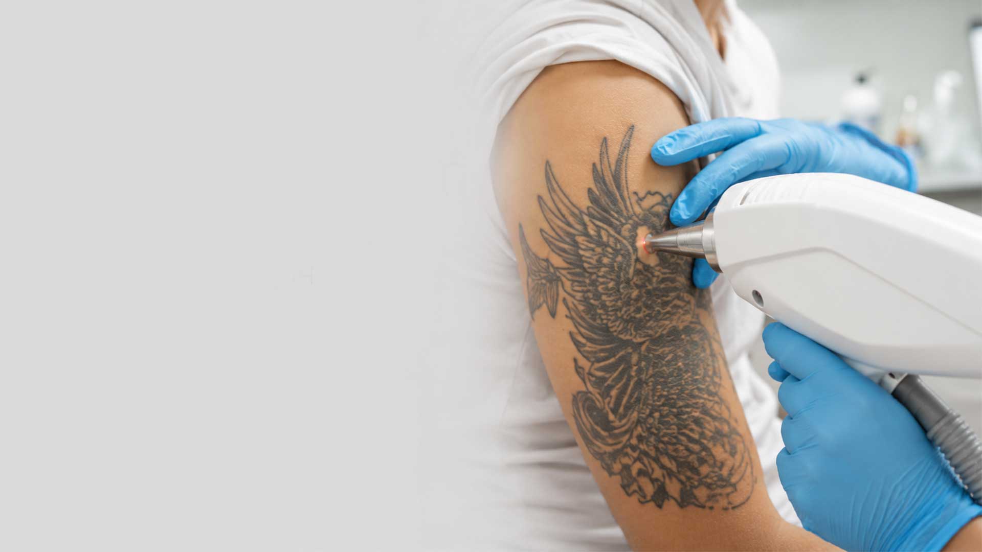 Laser tattoo removal treatment in Las Vegas